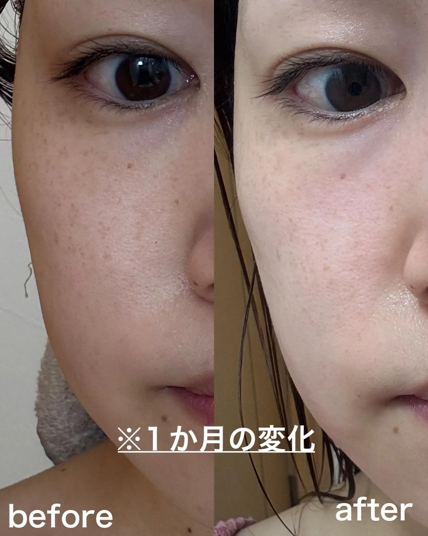 浅草橋にあるフェイシャルエステ専門店でシミ改善💡