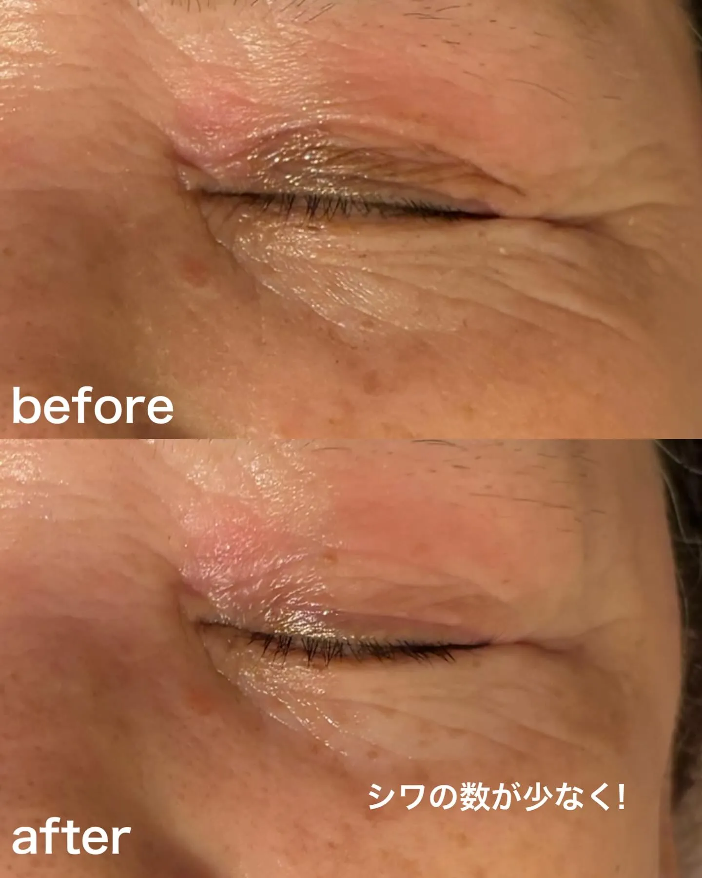 たった1回で👀ビフォーアフターにびっくり!浅草橋のフェイシャ...