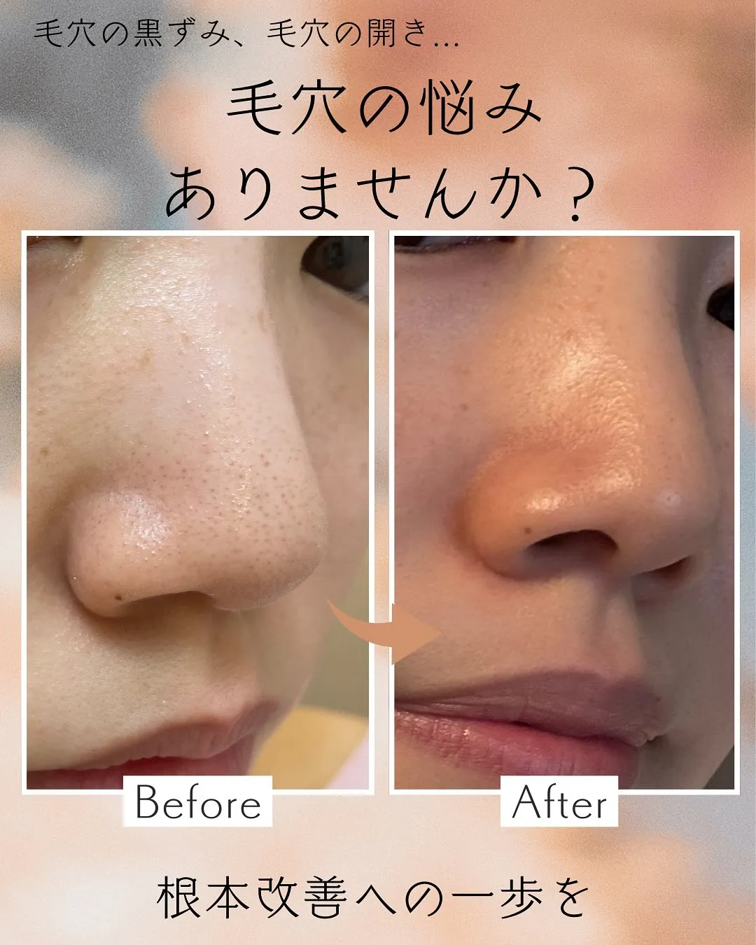 浅草橋のフェイシャルエステ専門店で毛穴ケア🍓