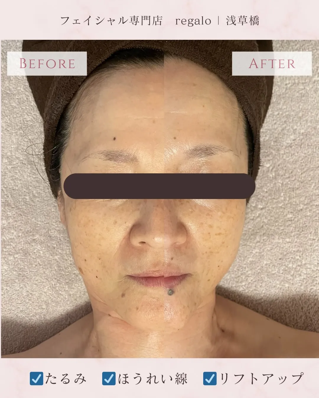 お顔のたるみは浅草橋のregaloで改善💪✨