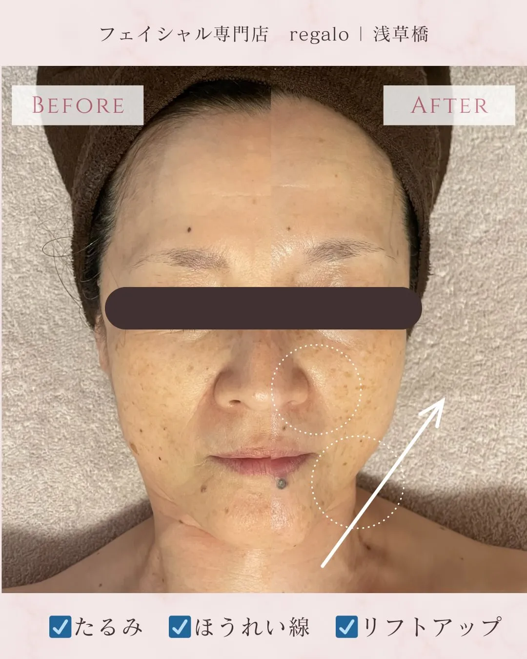 お顔のたるみは浅草橋のregaloで改善💪✨