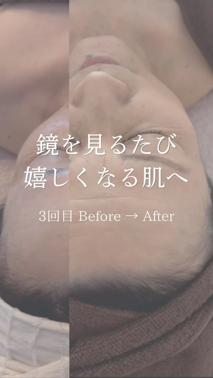 3回目のご来店で額のシワがこんなに薄くなりました✨✨
